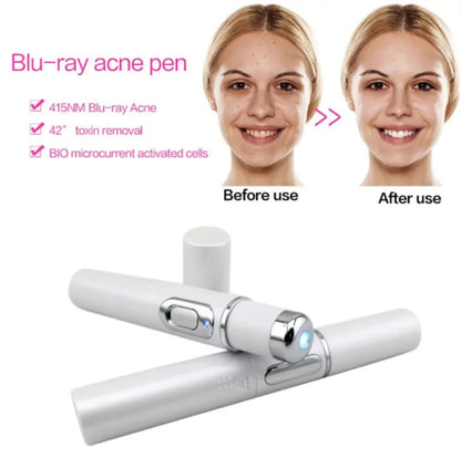LED Acne Pen – Effektiv lysterapi mod uren hud